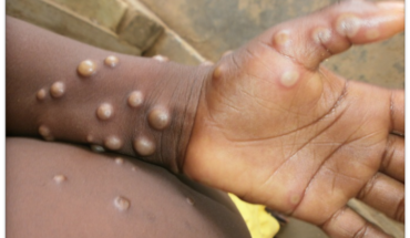 What is Monkeypox ?