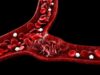 Stem Cell Transplant the only curative treatment for Sickle cell Disease