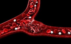Sickle cell Disease