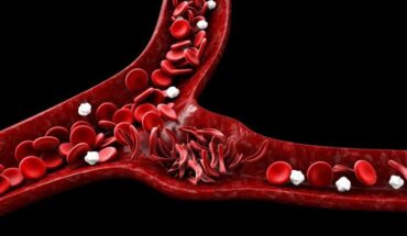 Stem Cell Transplant the only curative treatment for Sickle cell Disease
